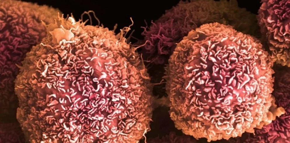 Una idea “imposible” derivó en un gran avance contra el cáncer de páncreas
